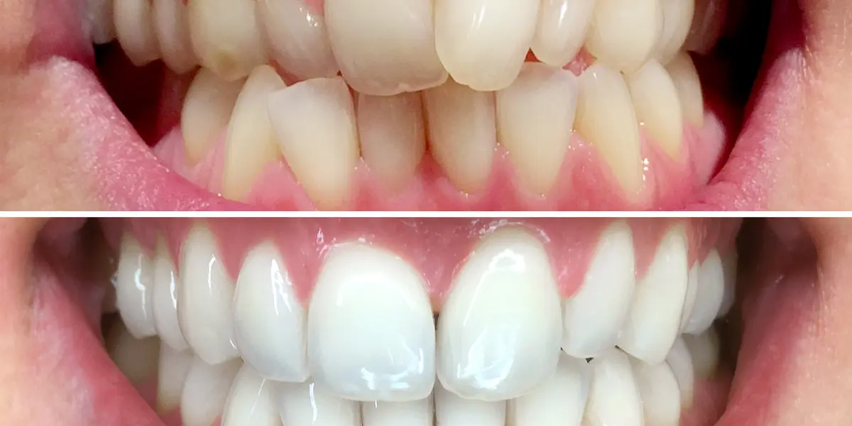 Alles rund ums Thema Zähne bleichen: Methoden, Kosten, Dauer, Vor- und Nachteile von Zähne bleichen.