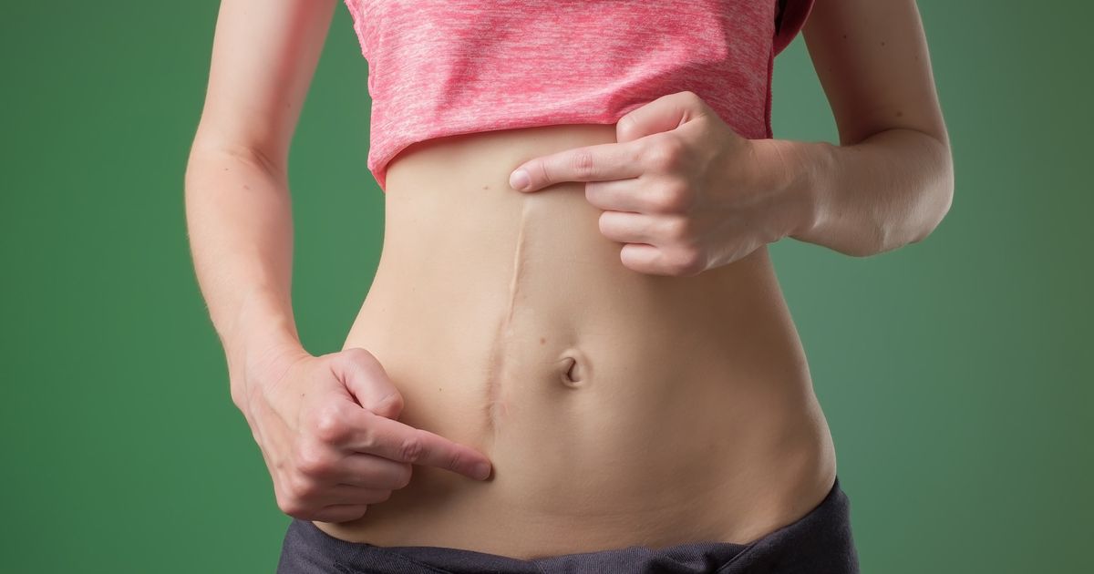 Scar Correction - Romed Meirer, MD