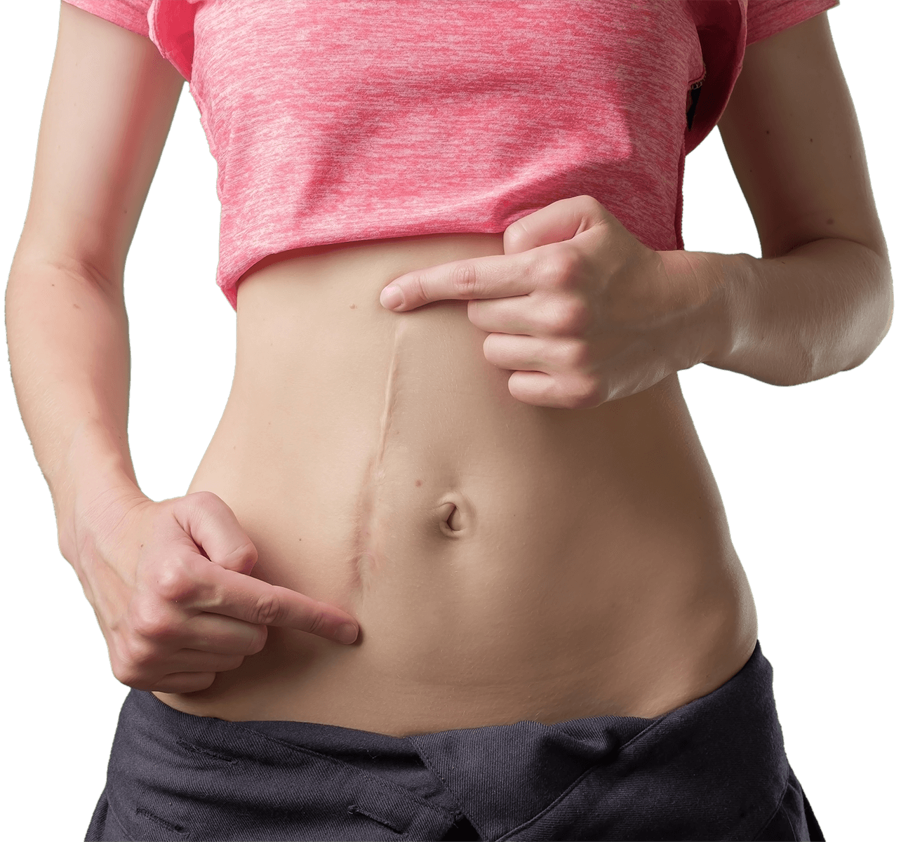 Scar Correction - Romed Meirer, MD