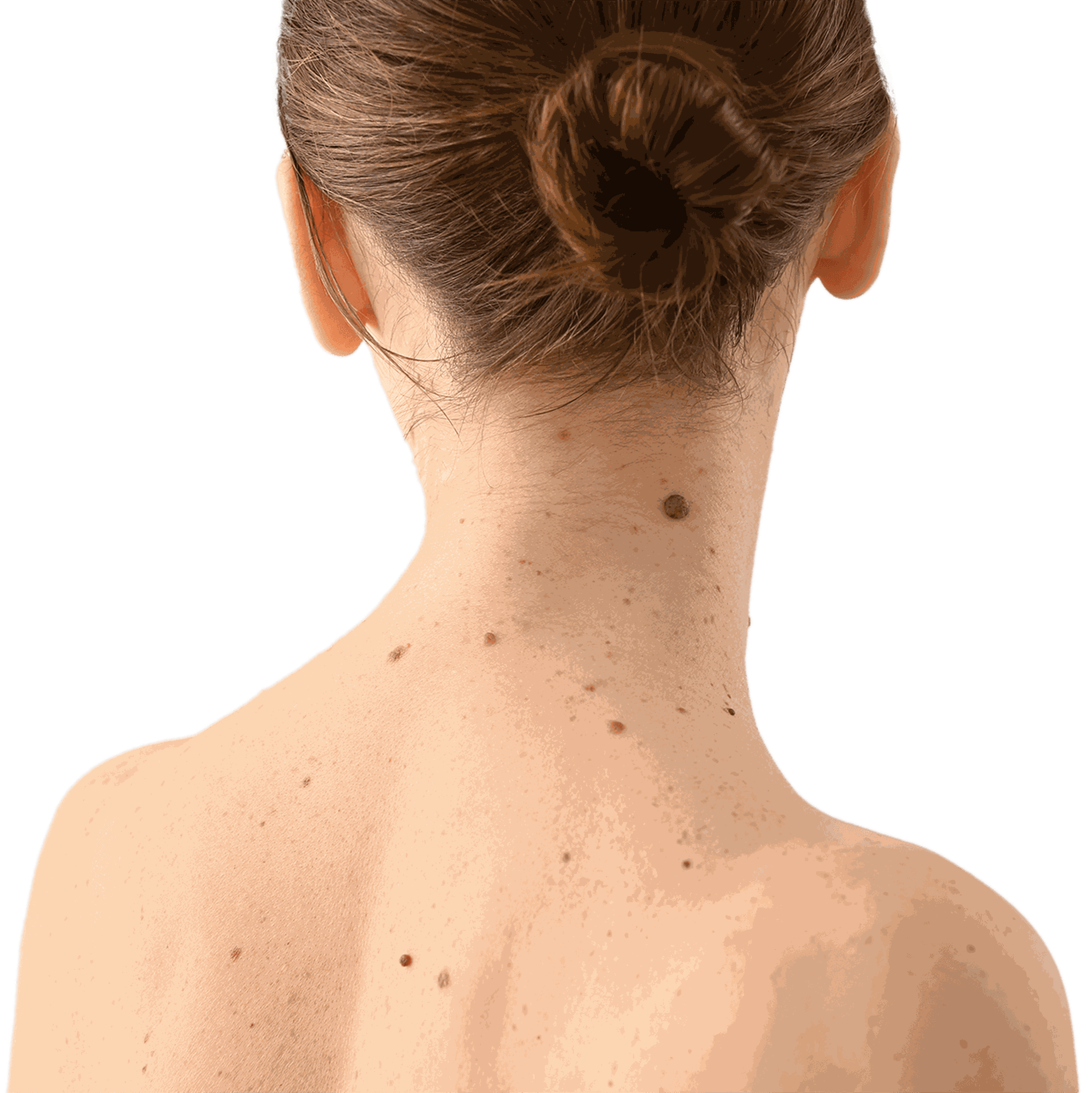 Hinterkopf und Rücken einer Frau mit etlichen Muttermalen