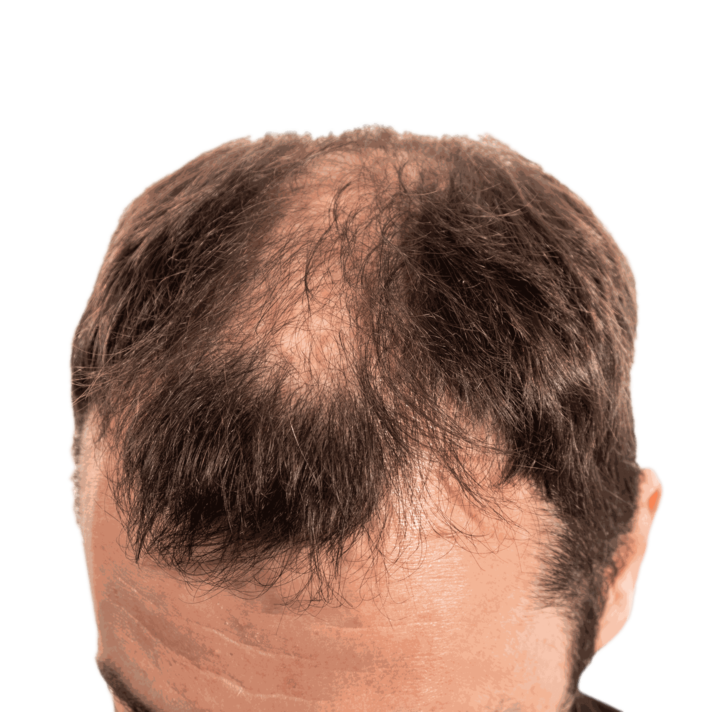 Kopf eines Mannes mit ausgehendem Haar