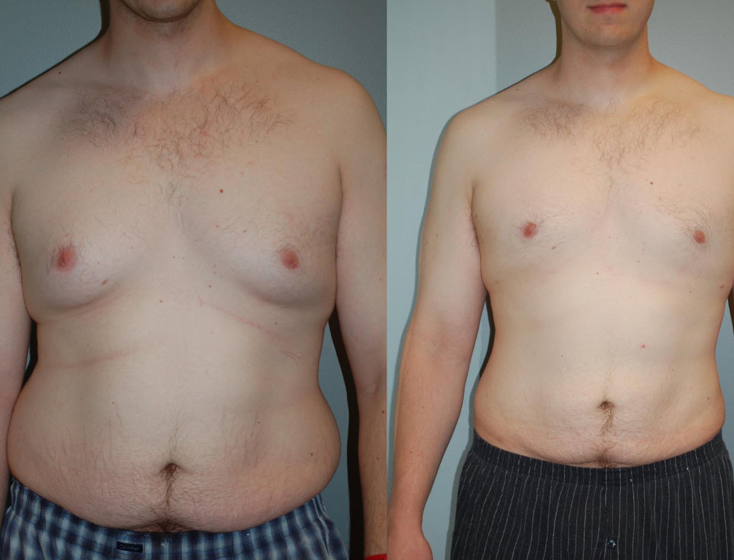 Vorher/Nachher Fotos von Mann nach einer Brustverkleinerung