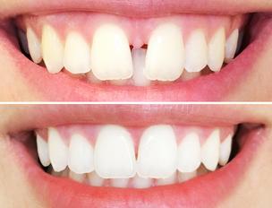 Tooth gap before after