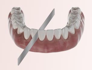 Tooth stripping for aligners
