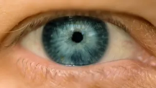 El glaucoma pigmentario