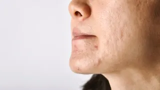 ¿Cómo tratar las cicatrices por acné?