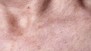 Consejos para manchas en la piel