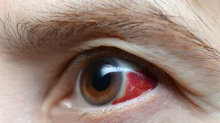 3 síntomas del desprendimiento de retina