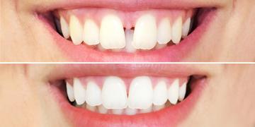 Tooth gap before after