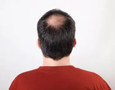tratamientos-para-alopecia-por-dr-sergio-vano