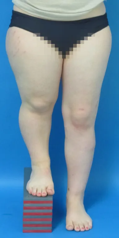 Abschluss der Beinverlängerung auf der linken Seite