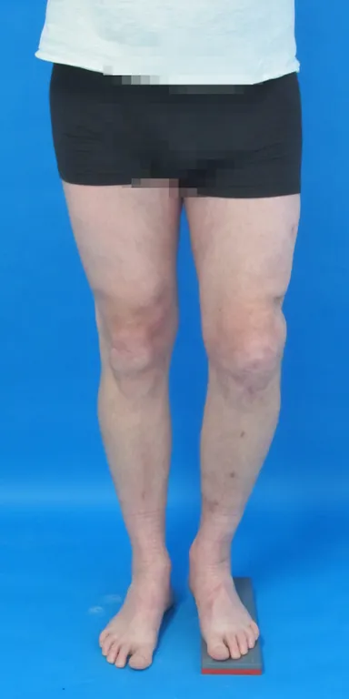 2cm Verkürzung und O-Bein-Stellung links