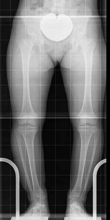Kurze Ober- und Unterschenkelknochen in O-Bein-Stellung
