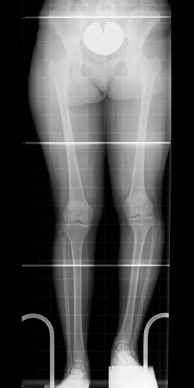 Verkürzung und deutliche Fehlstellung des linken Beines