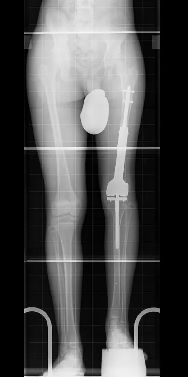 Verkürztes Bein nach Tumorentfernung