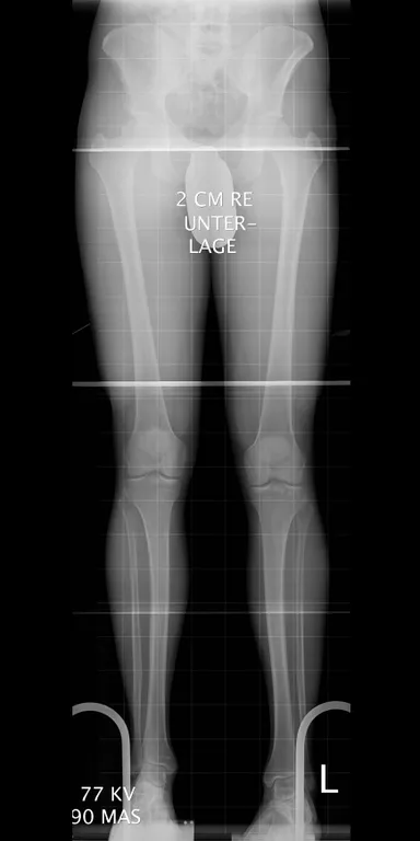 Unterschiedliche Kniehöhen im Röntgenbild