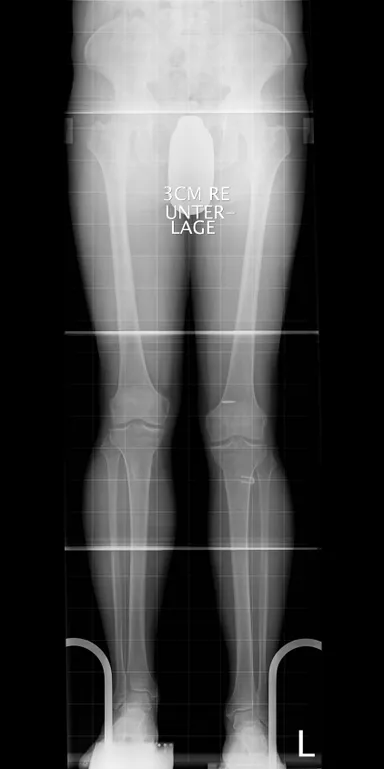 Unterschiedliche Kniehöhen im Röntgenbild