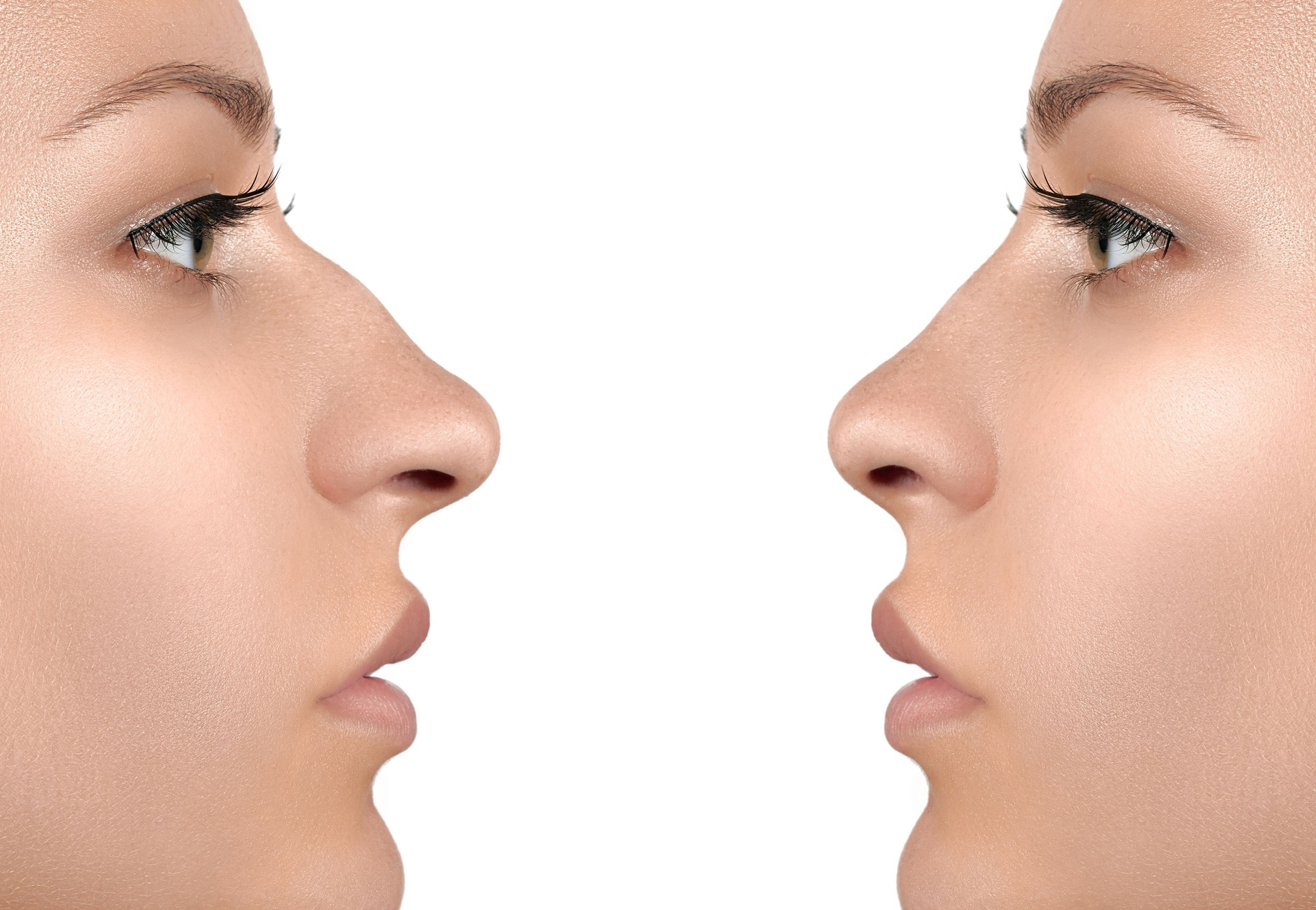 2 Profile einer Frau, einmal mit leichtem Nasenhöcker, einmal ohne