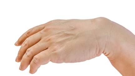 Handgelenk mit sichtbarem Ganglion