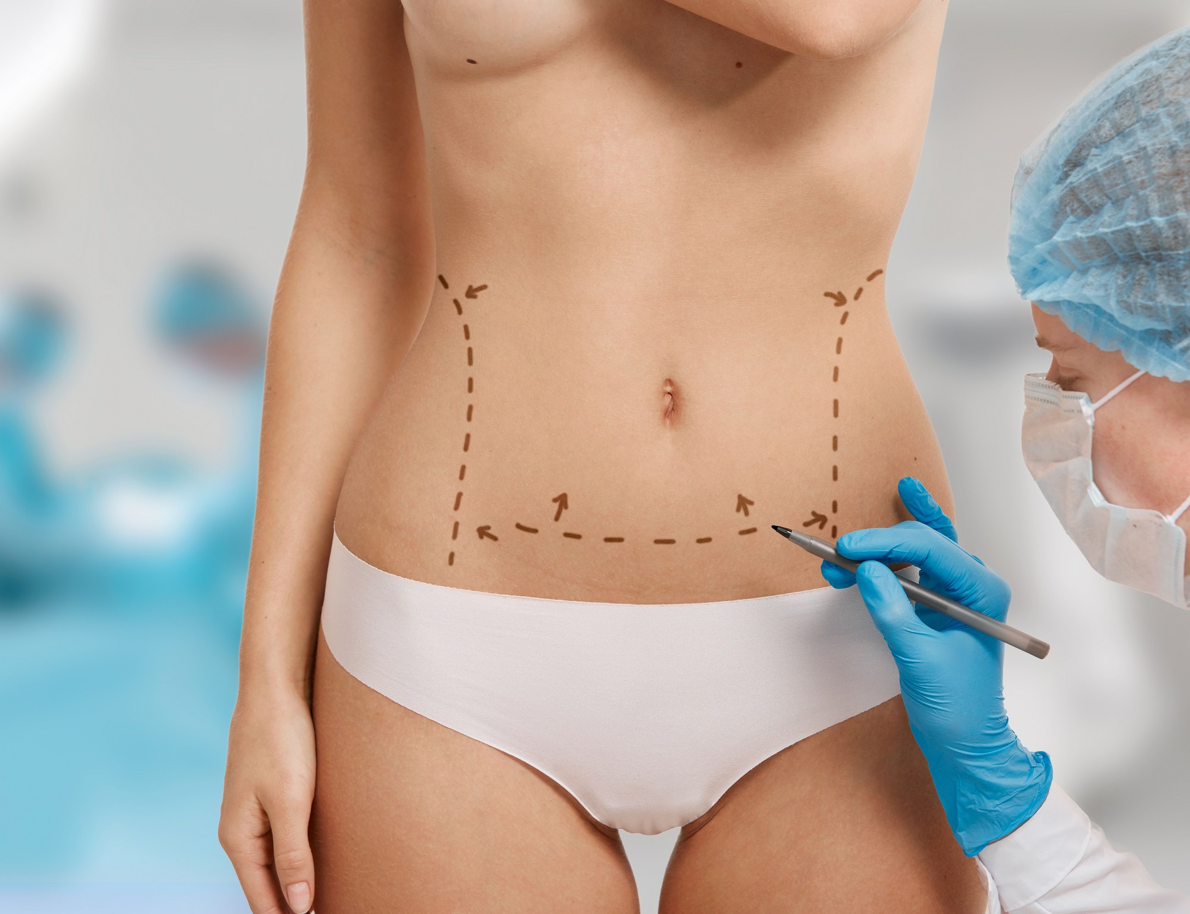 Schönheitschirurgin zeichnet gestrichelte Linien auf Bauch einer Patientin