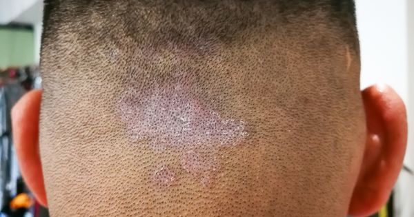 Dermatitis seborreica, una enfermedad que suele reaparecer - Noticias de El  Salvador
