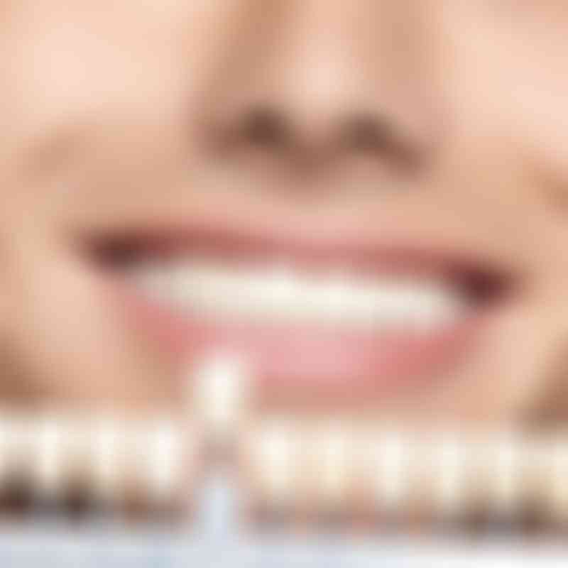 Facettes dentaires: bestsmile Veneers