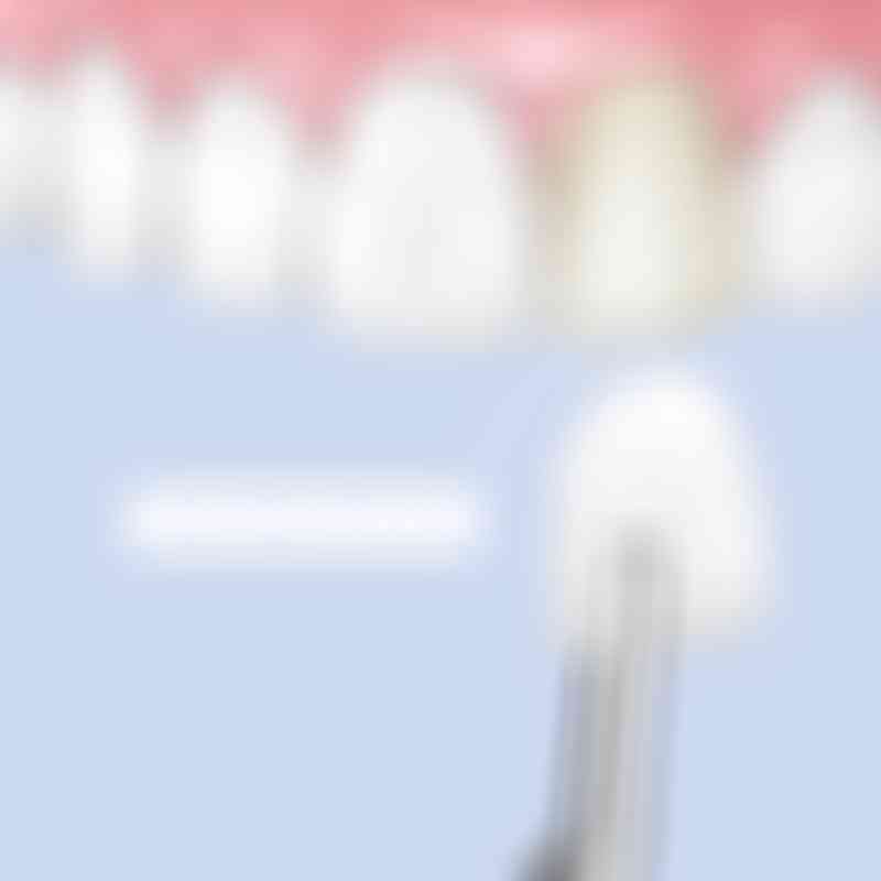 bestsmile Veneers teeth shaving