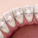 long-lasting and beautiful smile thanks to retainers