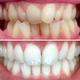 bestsmile teeth whitening