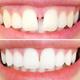 Diastema denti prima e dopo